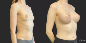 Breast Augmentation #86, before and after photo, view 2