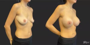 Breast Augmentation #89, before and after photo, view 2