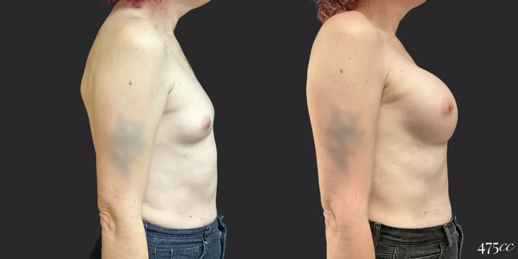 Breast Augmentation and Gender Affirming Surgery #76, before and after photo, view 3