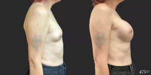 Breast Augmentation and Gender Affirming Surgery #76, before and after photo, view 3