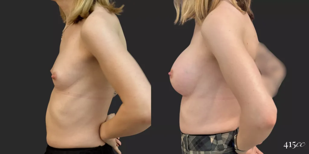 Breast Augmentation and Gender Affirming Surgery #77, before and after photo, view 3