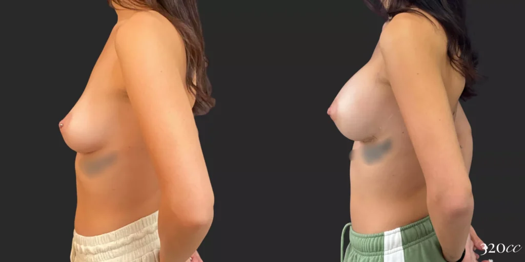 Breast Augmentation #78, before and after photo, view 3