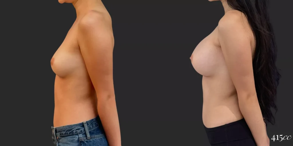 Breast Augmentation #79, before and after photo, view 3