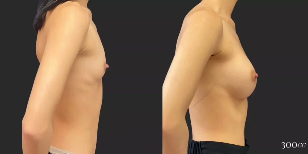 Breast Augmentation #81, before and after photo, view 3