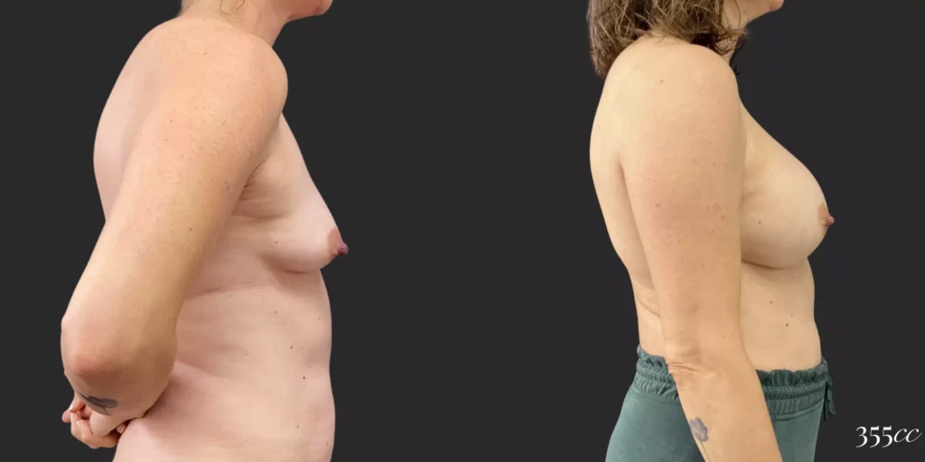 Breast Augmentation #83, before and after photo, view 3
