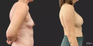 Breast Augmentation #83, before and after photo, view 3