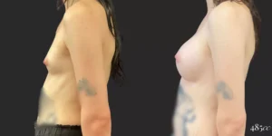 Breast Augmentation Gender Affirming Surgery #84, before and after photo, view 3