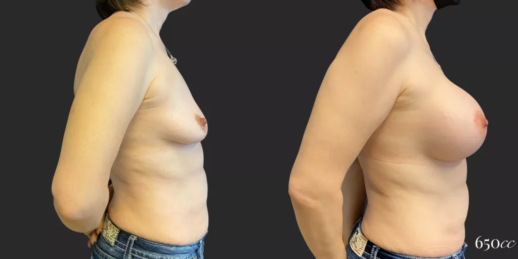 Breast Augmentation #85, before and after photo, view 3