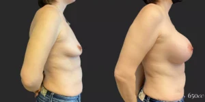 Breast Augmentation #85, before and after photo, view 3