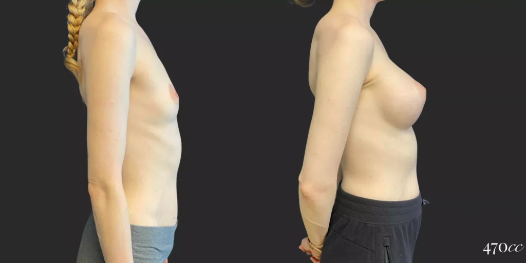 Breast Augmentation #86, before and after photo, view 3