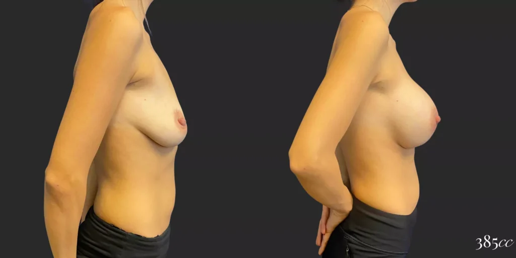 Breast Augmentation #89, before and after photo, view 3