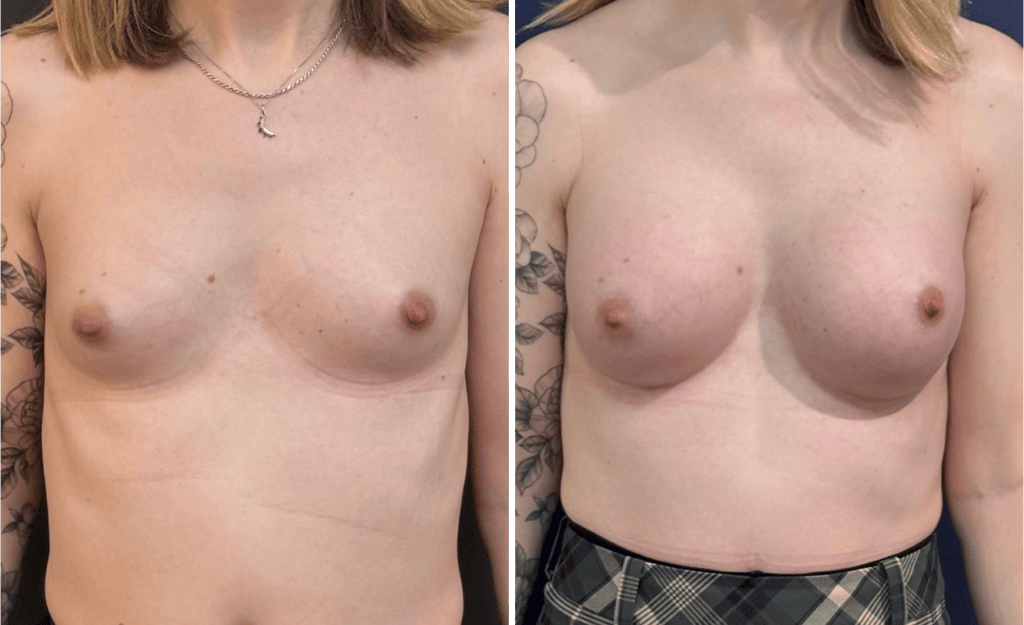 Gender Affirming Surgery #006, before and after photo