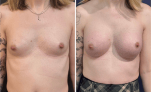 Gender Affirming Surgery #006, before and after photo