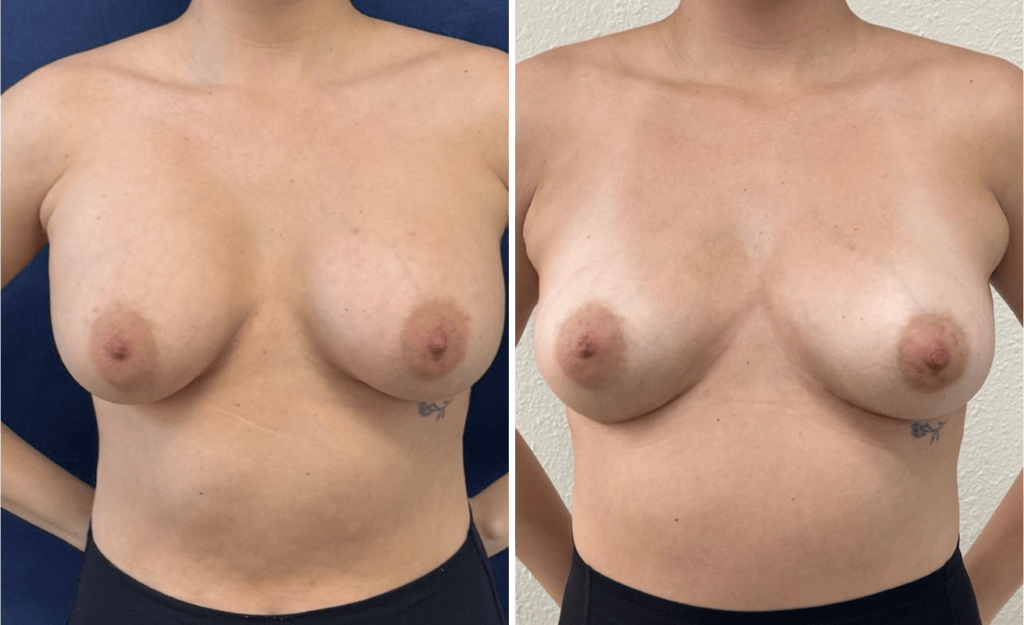 Breast Implant Removal #05, before and after photo