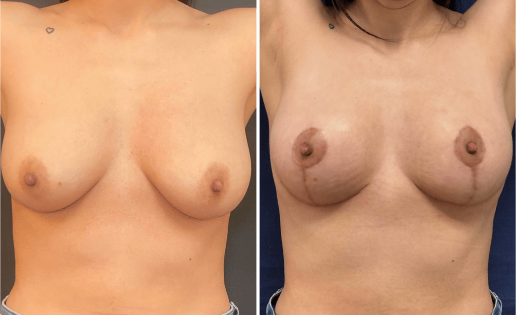 Breast Lift #008, before and after photo