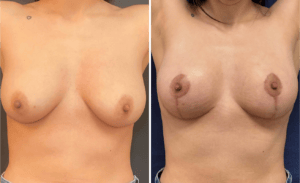 Breast Lift #008, before and after photo