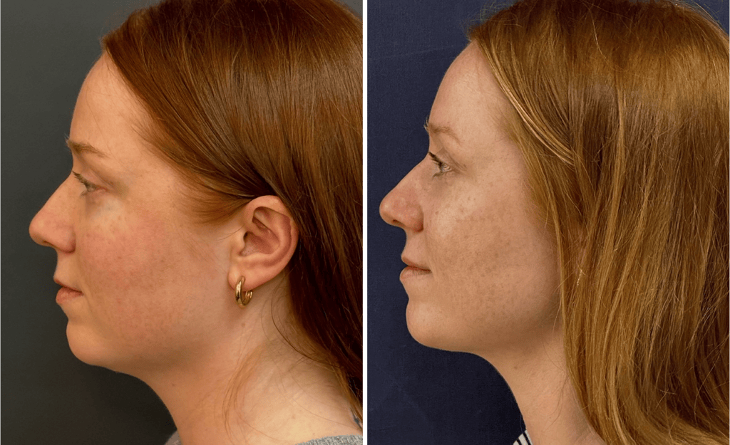Chin Liposuction #002, before and after photo
