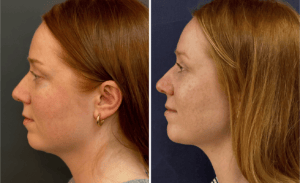 Chin Liposuction #002, before and after photo