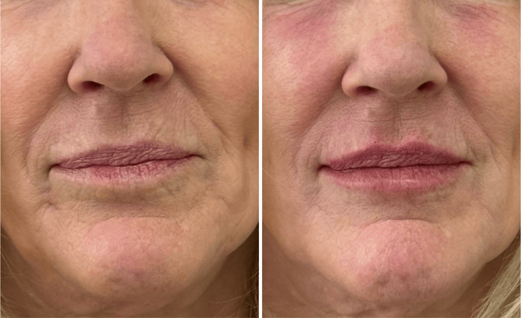 Injections #001, before and after photo