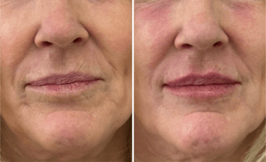 Injections #001, before and after photo