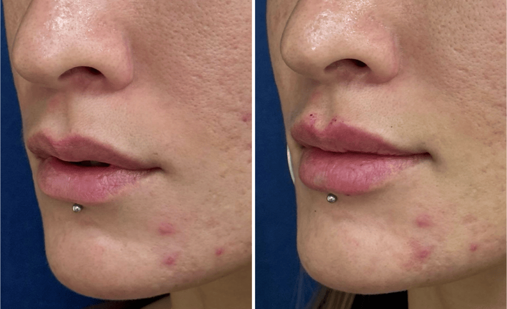 Injections #002, before and after photo