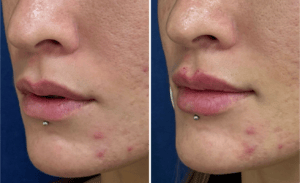 Injections #002, before and after photo