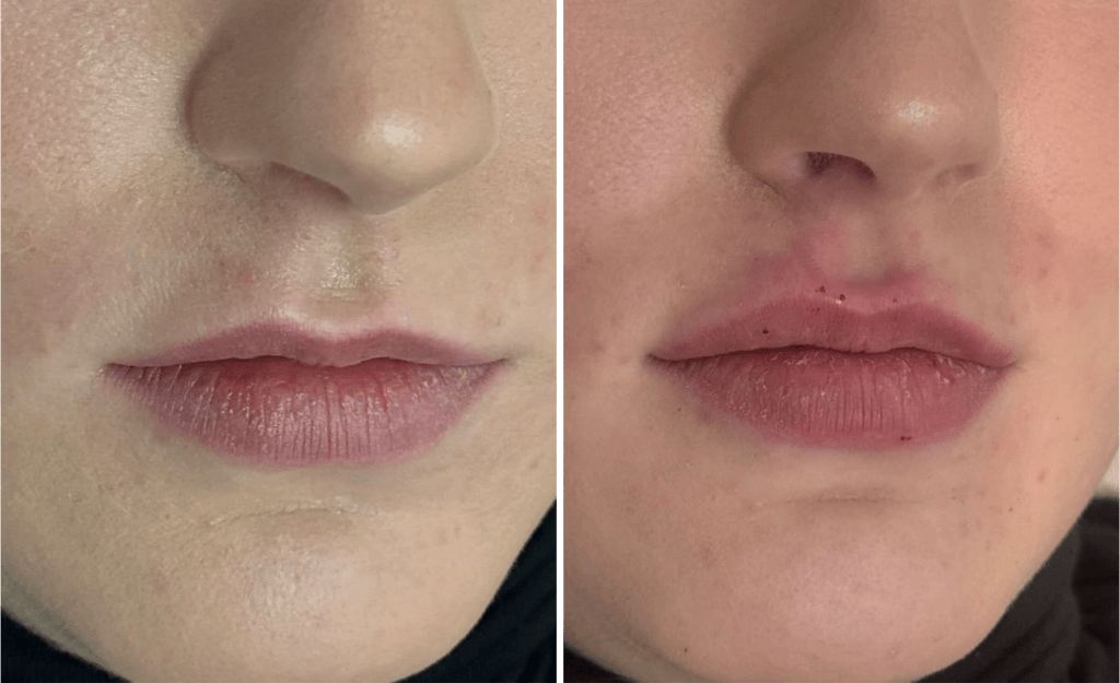 Injections #003, before and after photo