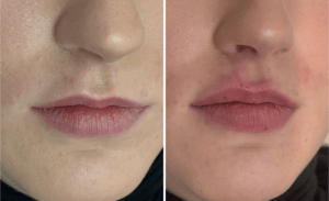Injections #003, before and after photo