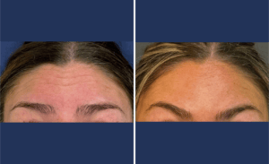 Injections #004, before and after photo