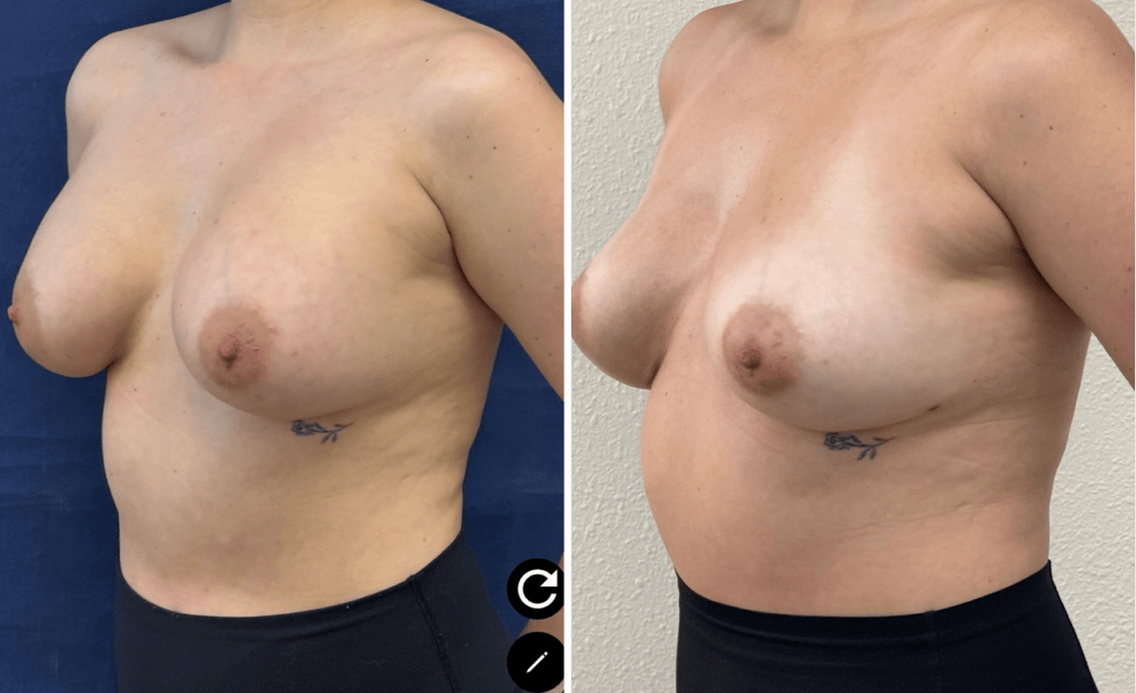 Breast Implant Removal #06