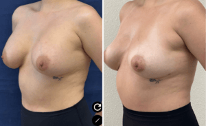 Breast Implant Removal #05, before and after photo, view 2