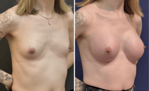 Gender Affirming Surgery #006, before and after photo, view 2