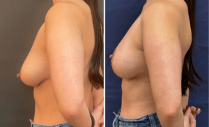 Breast Lift #008, before and after photo, view 2