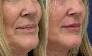 Injections #001, before and after photo, view 2