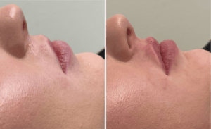 Injections #003, before and after photo, view 2