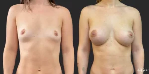 Breast Augmentation #91, before and after photo