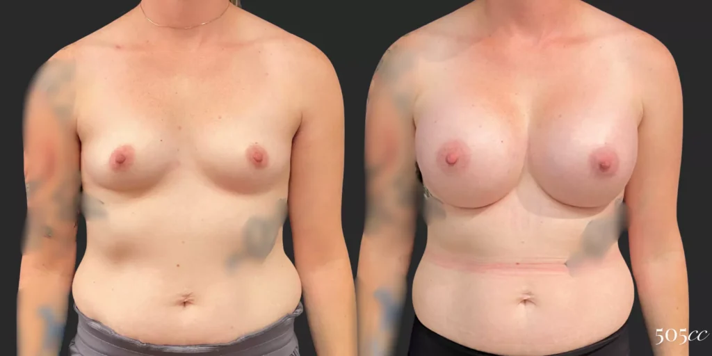 Breast Augmentation #92, before and after photo