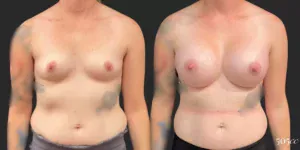 Breast Augmentation #92, before and after photo