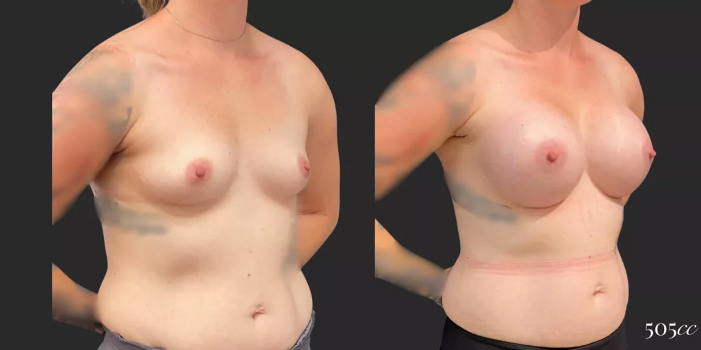 Breast Augmentation #92, before and after photo, view 2