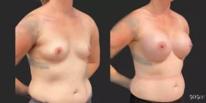 Breast Augmentation #92, before and after photo, view 2