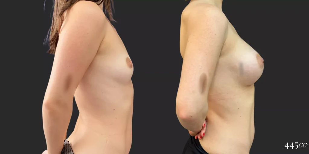 Breast Augmentation #91, before and after photo, view 3
