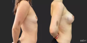 Breast Augmentation #91, before and after photo, view 3