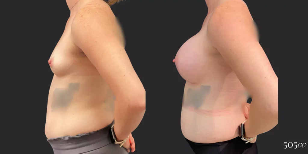 Breast Augmentation #92, before and after photo, view 3