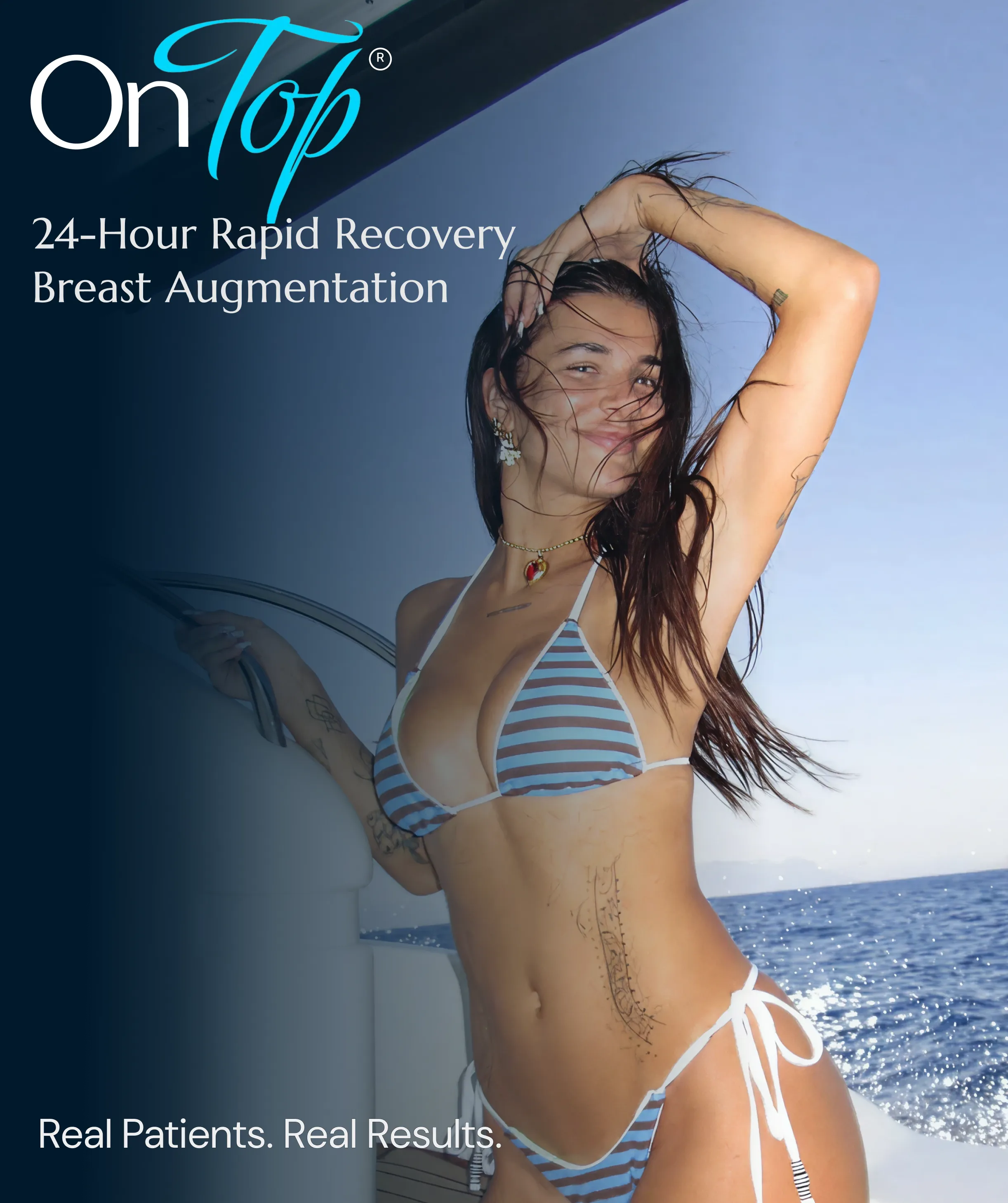 On Top Breast Augmentation