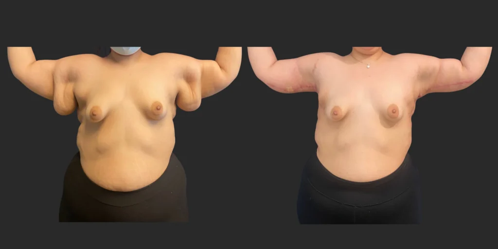 Arm Lift (Brachioplasty) #005, before and after photo