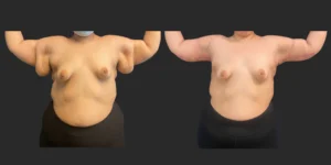 Arm Lift (Brachioplasty) #005, before and after photo