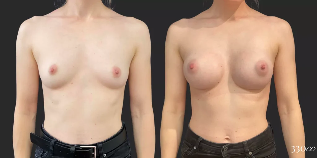 Breast Augmentation #95, before and after photo