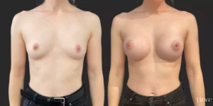 Breast Augmentation #95, before and after photo