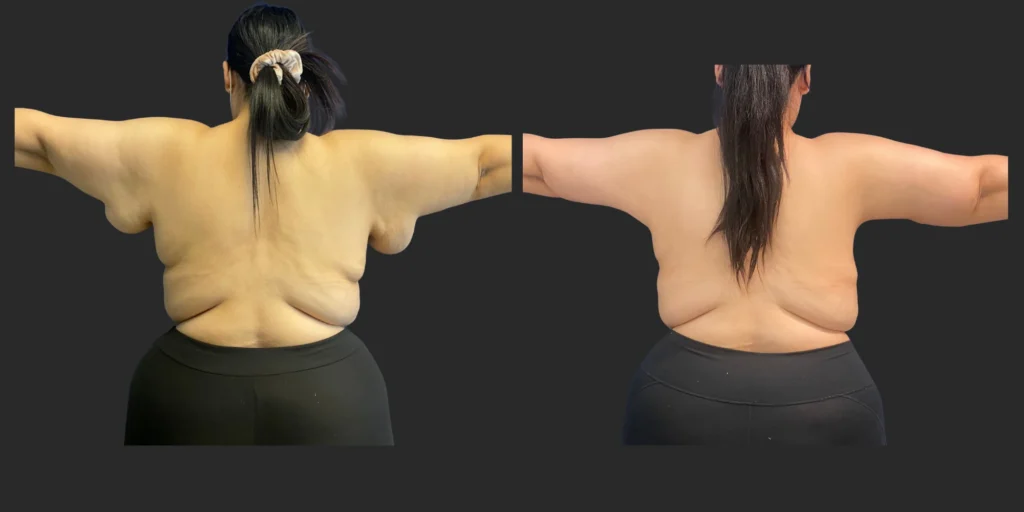 Arm Lift (Brachioplasty) #005, before and after photo, view 2