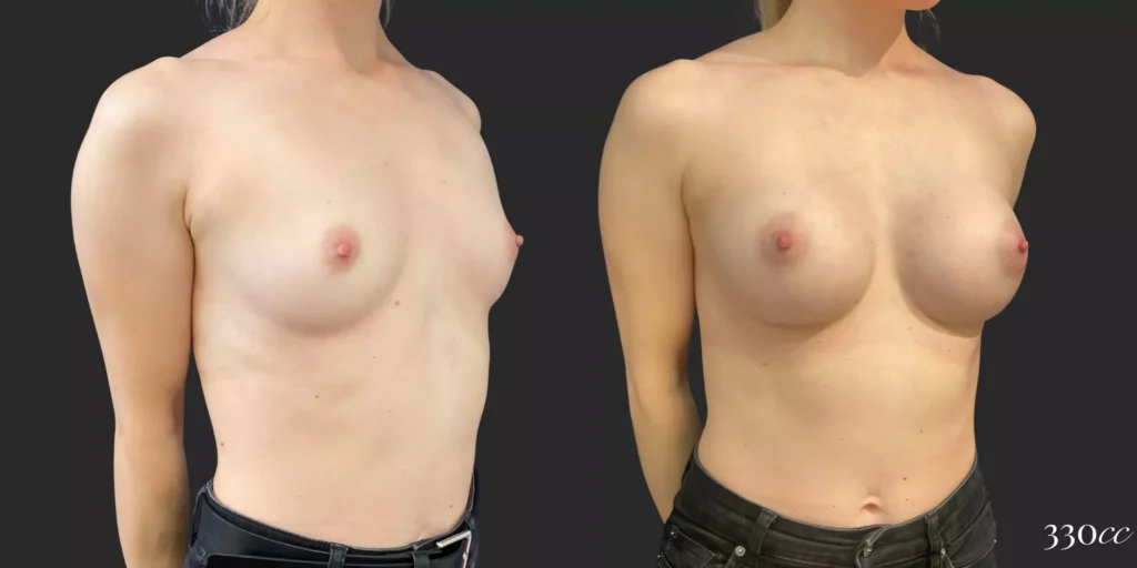 Breast Augmentation #95, before and after photo, view 2